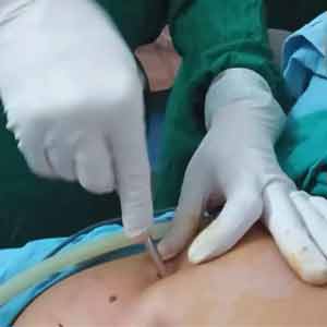 Diagnostic Hysterolaparoscopy