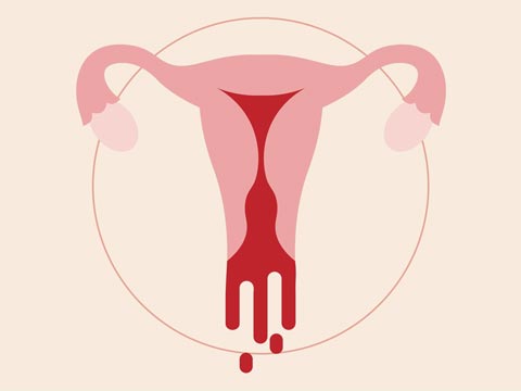Period problems and Heavy menstrual bleeding is very common, affecting up to 30% of women. 