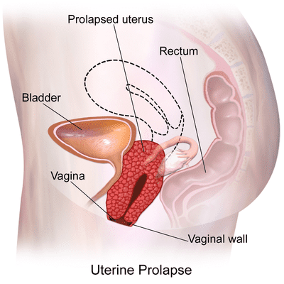 Uterine Prolapse treatment in borivali, mumbai