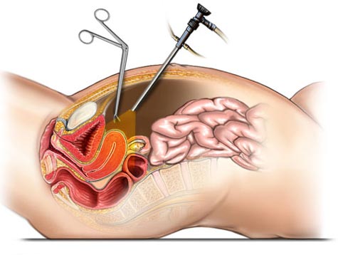 Laparoscopic Hysterectomy Doctor  Uterus removal surgery in Borivali