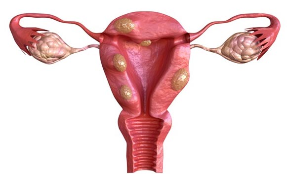Uterine fibroids are noncancerous (benign) tumours that develop on the uterine muscular tissue.